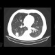 Carcinoma of colon, lienal flexure, large bowel ileus, lung metastasis: CT - Computed tomography